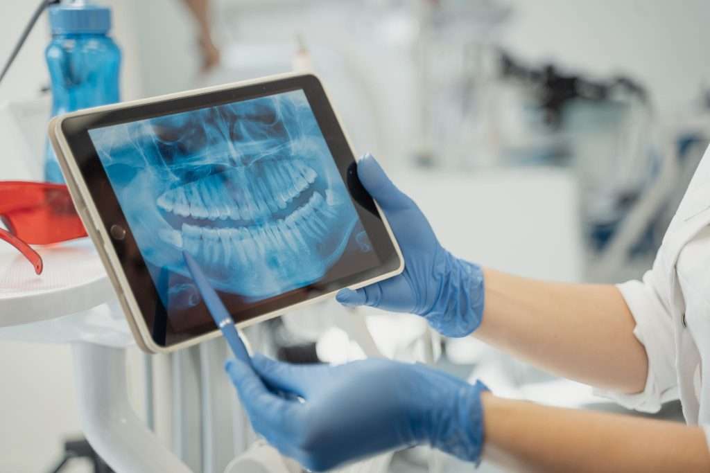 fogbeültetés vagy fogászati implantátum